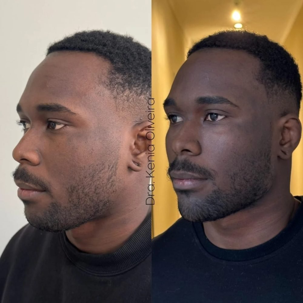 Resultado natural de harmonização facial masculina — definição de mandíbula