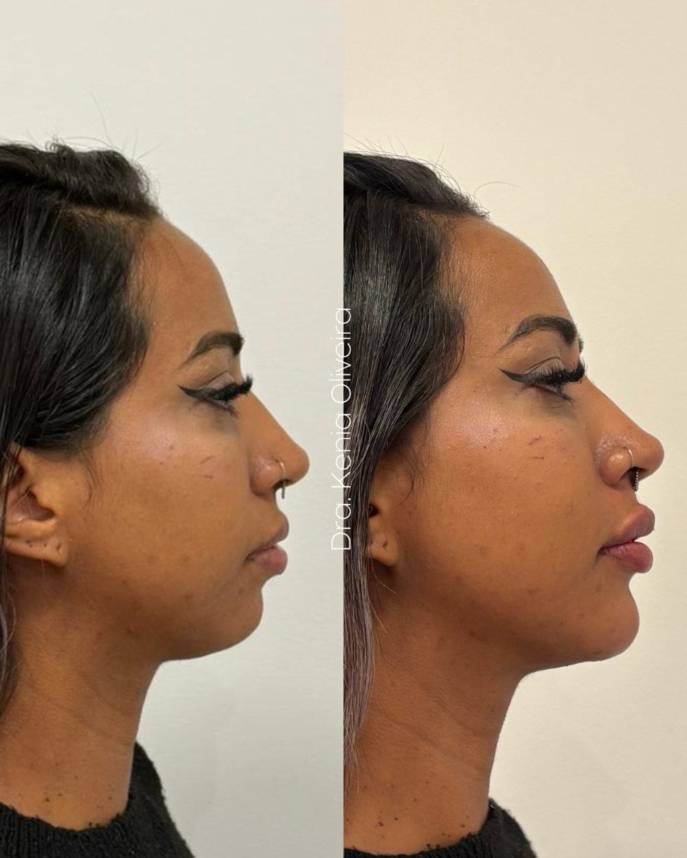 Antes e depois de harmonização facial feminina em São Paulo
