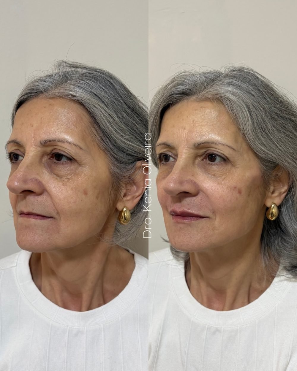 Antes e depois de correção de olheiras e contorno facial